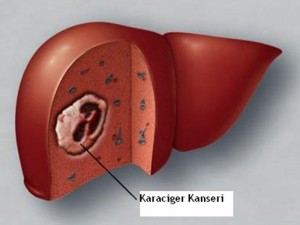 karaciger-kanseri-tedavisi